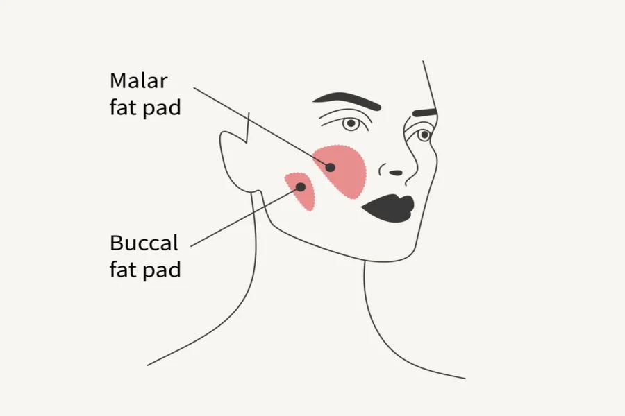 Buccal Fat